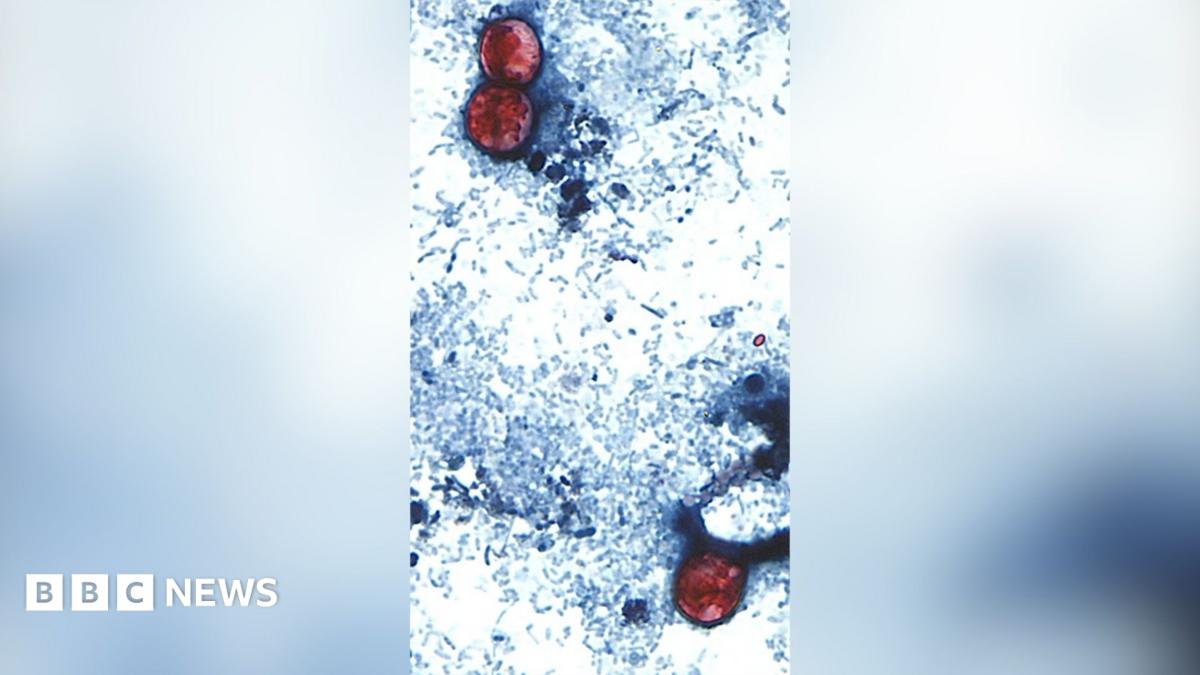 US reports first two deaths linked to parasitic infection outbreak