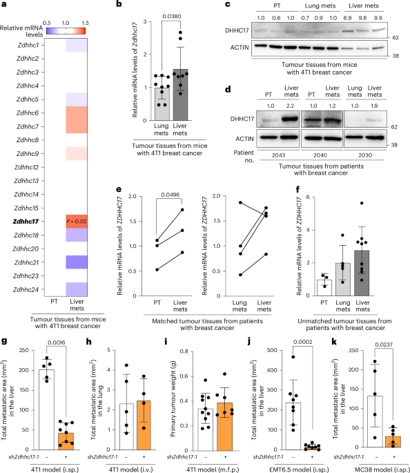 Palmitate promotes liver metastases by decreasing neutrophil antitumour behaviour