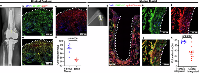 GREM1 acts in leptin receptor-expressing skeletal cells to mediate peri-implant fibrosis