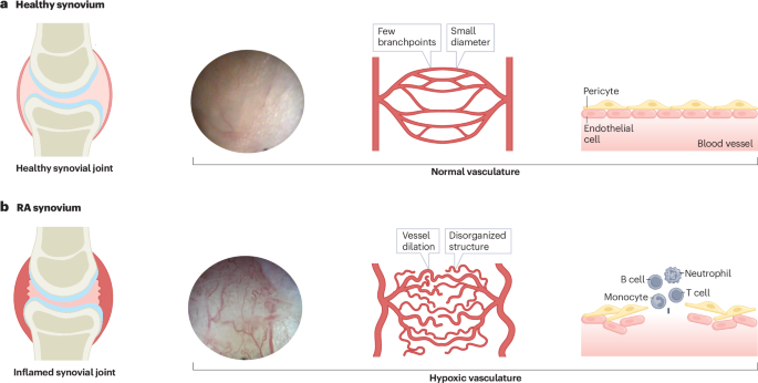 Hypoxia as an amplifier of synovial inflammation in rheumatoid arthritis