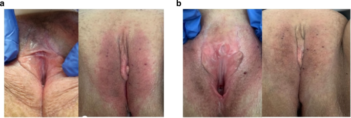 Improvement of signs of vulvovaginal chronic graft-versus-host disease and genital syndrome of menopause with non-ablati