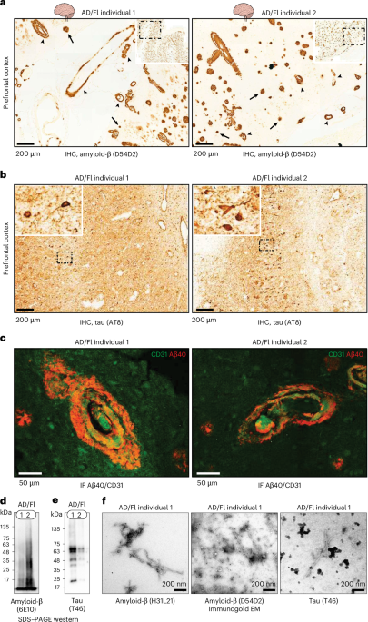 Distinct amyloid-β filament fold in individuals with APP Flemish mutation